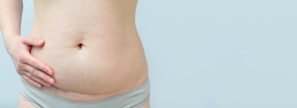 lipo c section shelf C-Section How To Get Rid Of