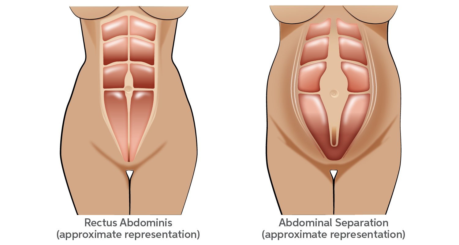The Ultimate Mother’s Guide to Diastasis Recti Resources; Healing Abdominal Separation Postpartum | SRC Health